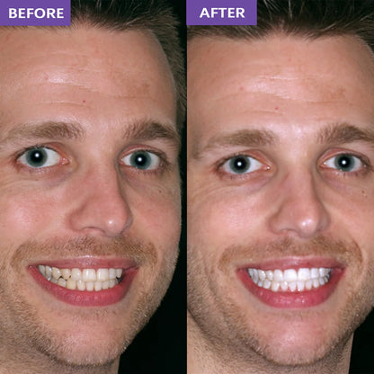 OraClear Purple Whitening Strips